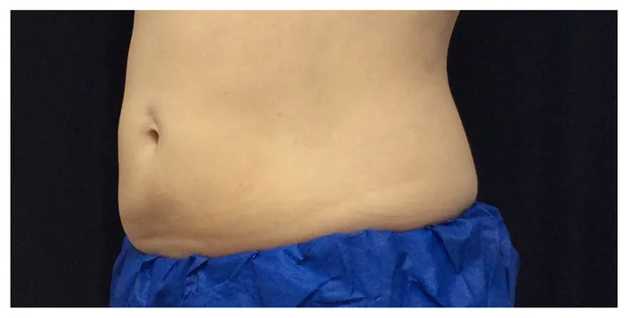 After CoolSculpting before and after at Florida Aesthetics and Wellness in Brandon, FL