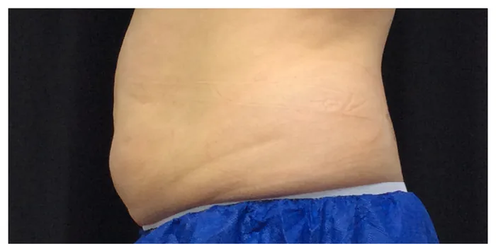 Before CoolSculpting before and after at Florida Aesthetics and Wellness in Brandon, FL