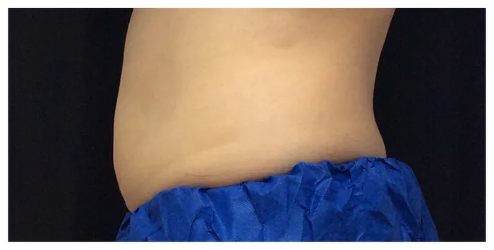After CoolSculpting before and after at Florida Aesthetics and Wellness in Brandon, FL