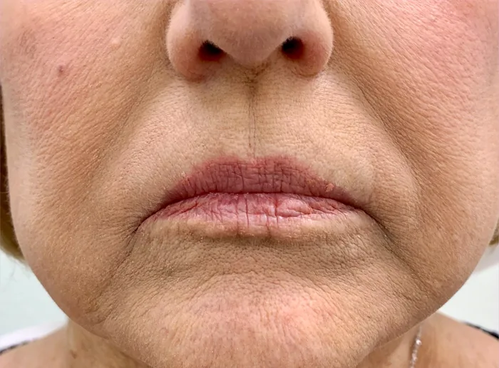 Before Lip Filler before and after at Florida Aesthetics and Wellness in Brandon, FL