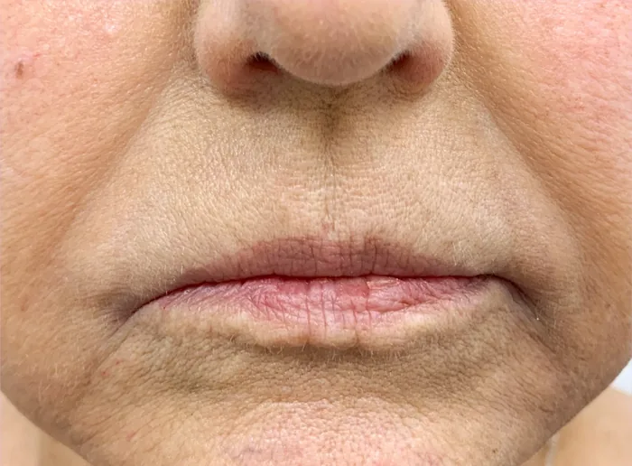 After Lip Filler before and after at Florida Aesthetics and Wellness in Brandon, FL