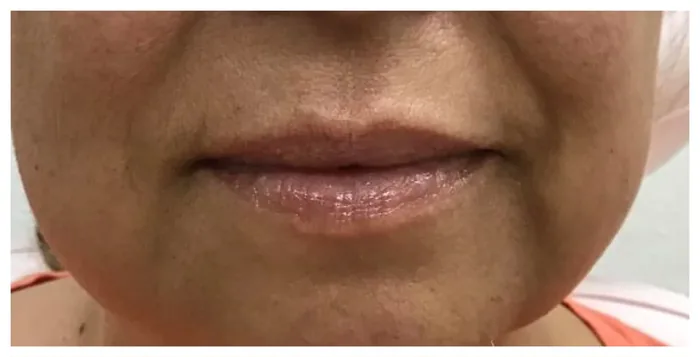 Before Lip Filler before and after at Florida Aesthetics and Wellness in Brandon, FL