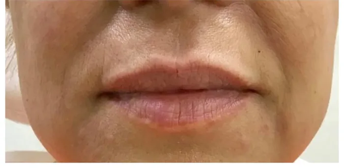 After Lip Filler before and after at Florida Aesthetics and Wellness in Brandon, FL