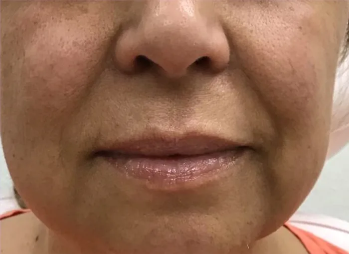 Before Lip Filler before and after at Florida Aesthetics and Wellness in Brandon, FL