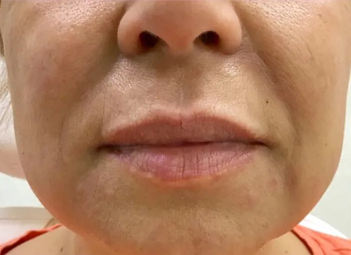 After Lip Filler before and after at Florida Aesthetics and Wellness in Brandon, FL