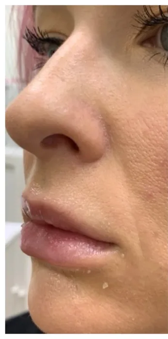Before Lip Filler before and after at Florida Aesthetics and Wellness in Brandon, FL