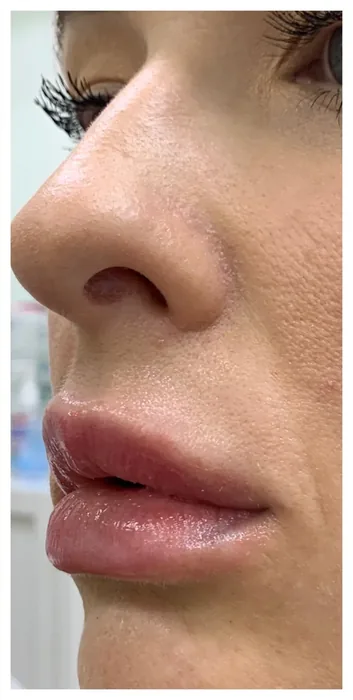 After Lip Filler before and after at Florida Aesthetics and Wellness in Brandon, FL