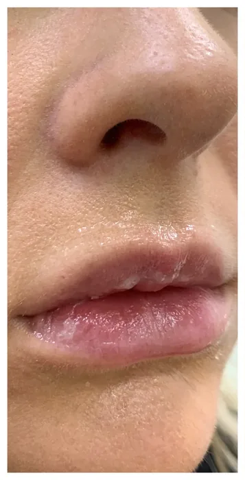 Before Lip Filler before and after at Florida Aesthetics and Wellness in Brandon, FL