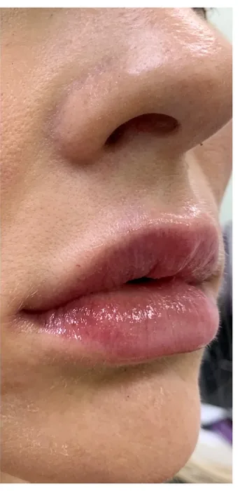 After Lip Filler before and after at Florida Aesthetics and Wellness in Brandon, FL