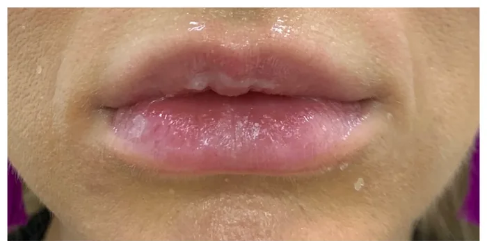 Before Lip Filler before and after at Florida Aesthetics and Wellness in Brandon, FL