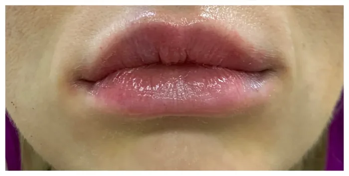 After Lip Filler before and after at Florida Aesthetics and Wellness in Brandon, FL