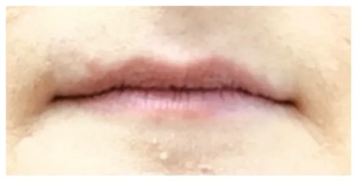 Before Lip Filler before and after at Florida Aesthetics and Wellness in Brandon, FL