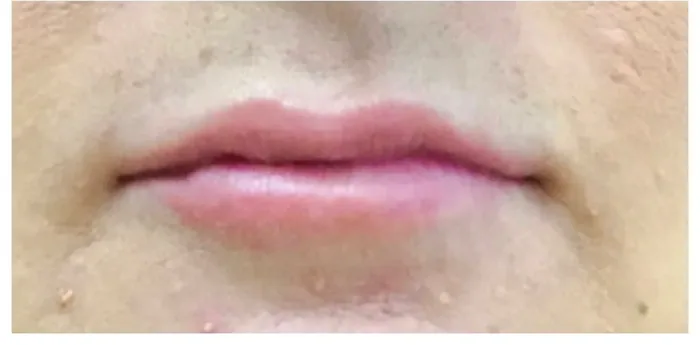 After Lip Filler before and after at Florida Aesthetics and Wellness in Brandon, FL