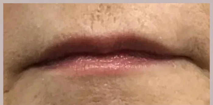 Before Lip Filler before and after at Florida Aesthetics and Wellness in Brandon, FL