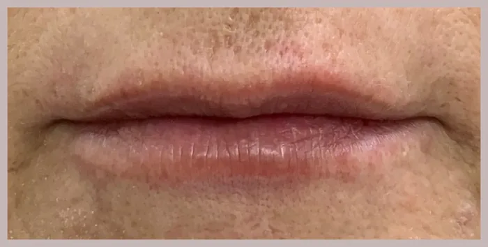 After Lip Filler before and after at Florida Aesthetics and Wellness in Brandon, FL