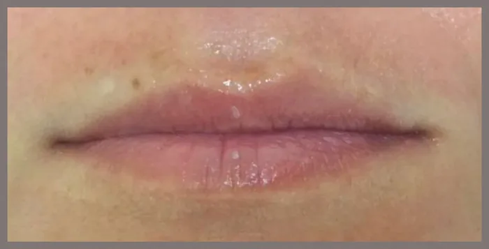 Before Lip Filler before and after at Florida Aesthetics and Wellness in Brandon, FL