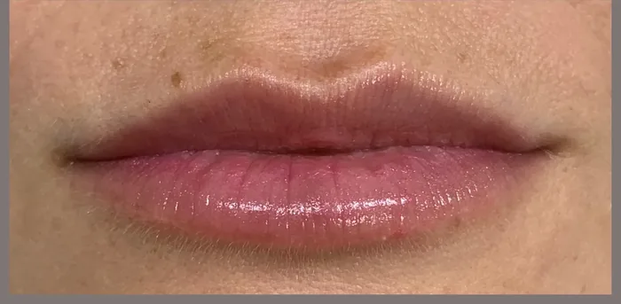 After Lip Filler before and after at Florida Aesthetics and Wellness in Brandon, FL