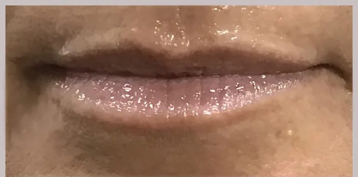 Before Lip Filler before and after at Florida Aesthetics and Wellness in Brandon, FL