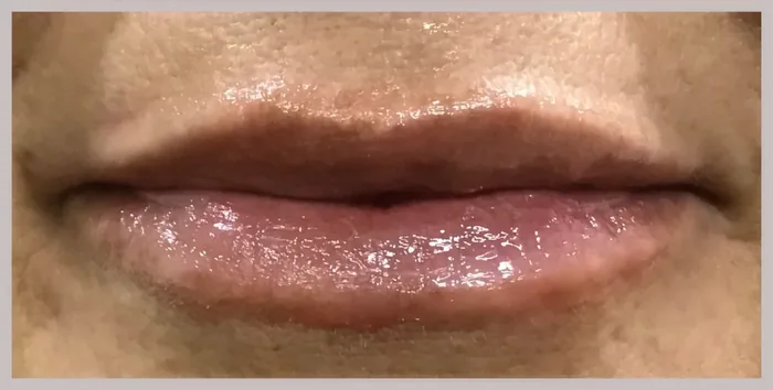 After Lip Filler before and after at Florida Aesthetics and Wellness in Brandon, FL