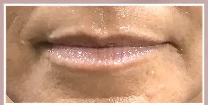 Before Lip Filler before and after at Florida Aesthetics and Wellness in Brandon, FL