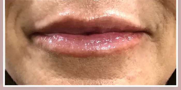 After Lip Filler before and after at Florida Aesthetics and Wellness in Brandon, FL