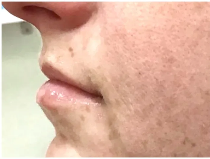 Before Lip Filler before and after at Florida Aesthetics and Wellness in Brandon, FL