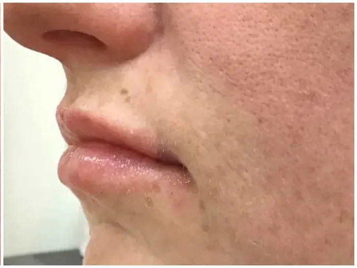 After Lip Filler before and after at Florida Aesthetics and Wellness in Brandon, FL