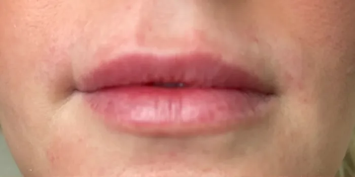 Before Lip Filler before and after at Florida Aesthetics and Wellness in Brandon, FL