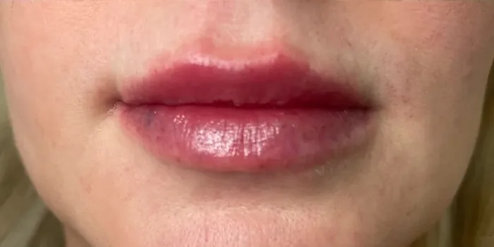 After Lip Filler before and after at Florida Aesthetics and Wellness in Brandon, FL