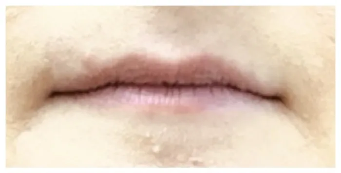 Before Lip Filler before and after at Florida Aesthetics and Wellness in Brandon, FL