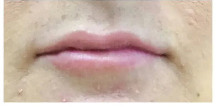After Lip Filler before and after at Florida Aesthetics and Wellness in Brandon, FL