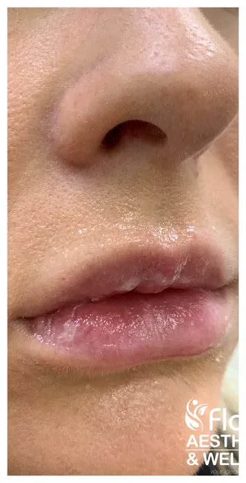 Before Lip Filler before and after at Florida Aesthetics and Wellness in Brandon, FL