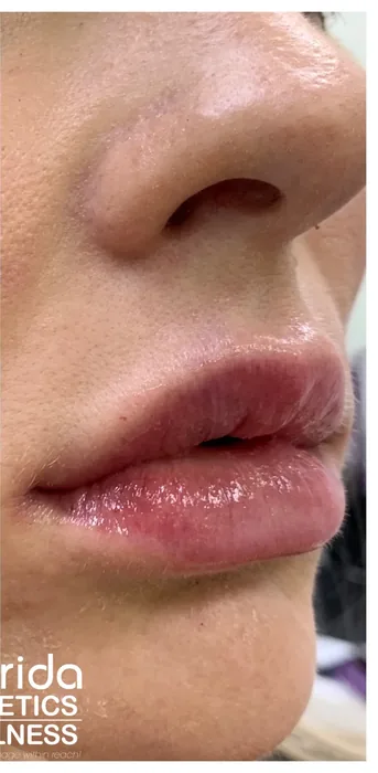 After Lip Filler before and after at Florida Aesthetics and Wellness in Brandon, FL