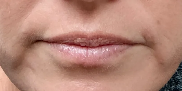 Before Lip Filler before and after at Florida Aesthetics and Wellness in Brandon, FL