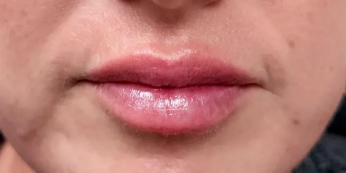 After Lip Filler before and after at Florida Aesthetics and Wellness in Brandon, FL