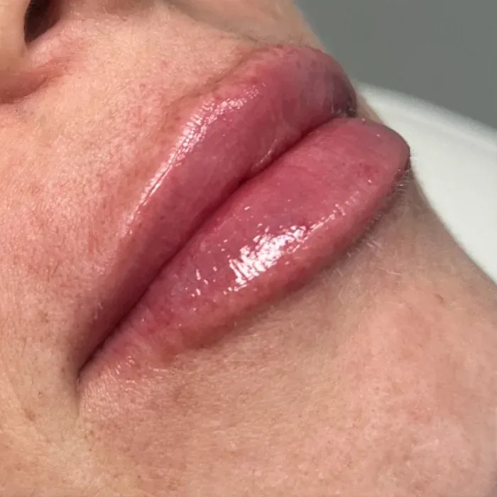 Before Lip Filler before and after at Florida Aesthetics and Wellness in Brandon, FL