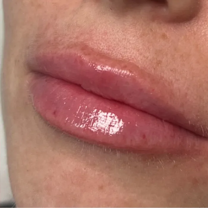 After Lip Filler before and after at Florida Aesthetics and Wellness in Brandon, FL