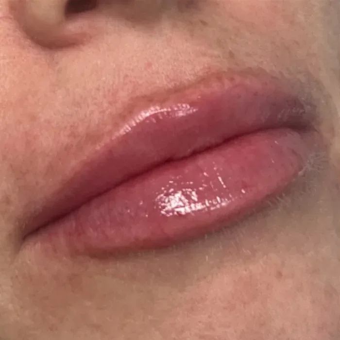 Before Lip Filler before and after at Florida Aesthetics and Wellness in Brandon, FL
