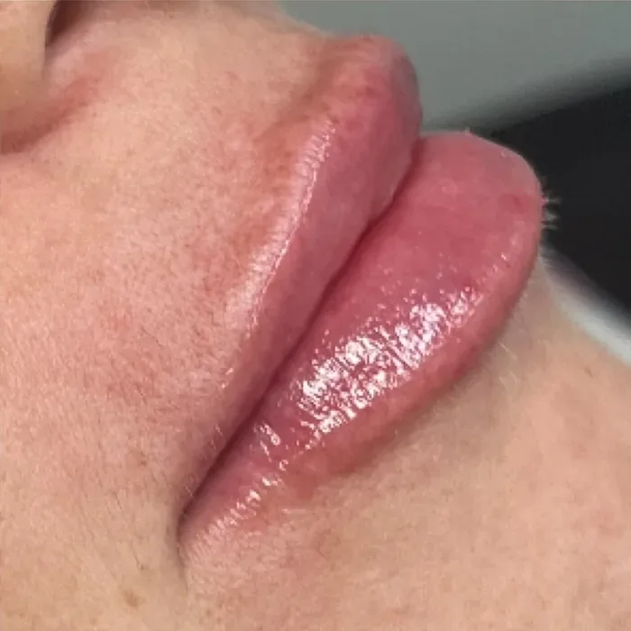 After Lip Filler before and after at Florida Aesthetics and Wellness in Brandon, FL