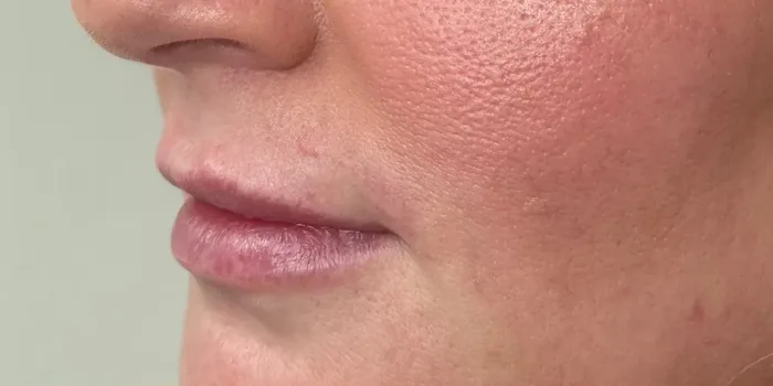 Before Lip Filler before and after at Florida Aesthetics and Wellness in Brandon, FL