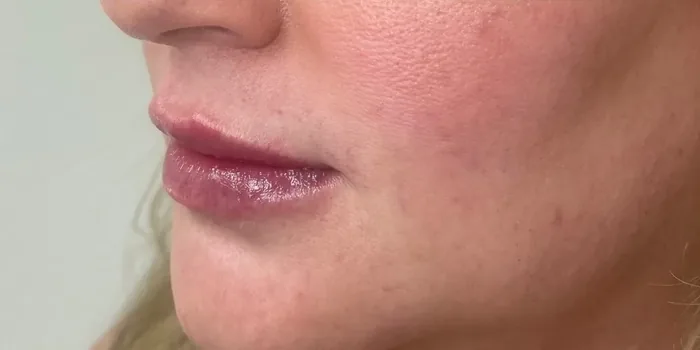 After Lip Filler before and after at Florida Aesthetics and Wellness in Brandon, FL