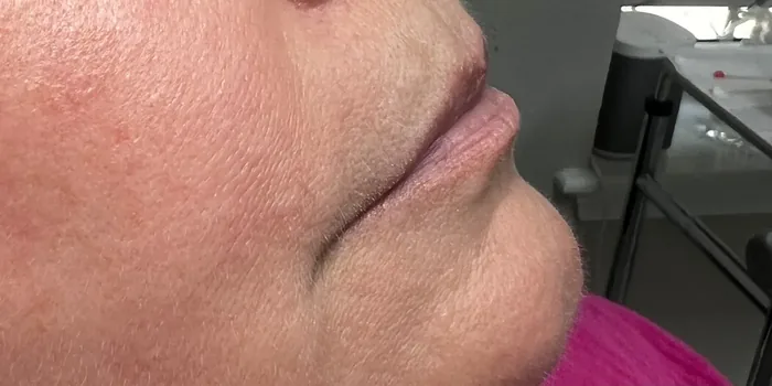 Before Lip Filler before and after at Florida Aesthetics and Wellness in Brandon, FL