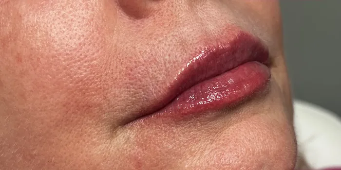 After Lip Filler before and after at Florida Aesthetics and Wellness in Brandon, FL