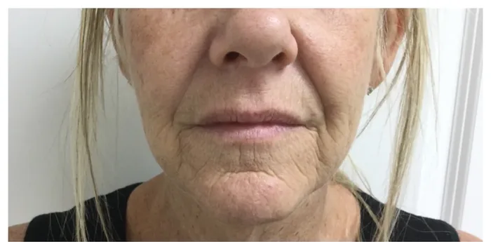 Before Lip Filler before and after at Florida Aesthetics and Wellness in Brandon, FL