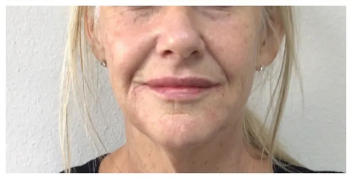 After Lip Filler before and after at Florida Aesthetics and Wellness in Brandon, FL