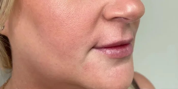 Before Lip Filler before and after at Florida Aesthetics and Wellness in Brandon, FL
