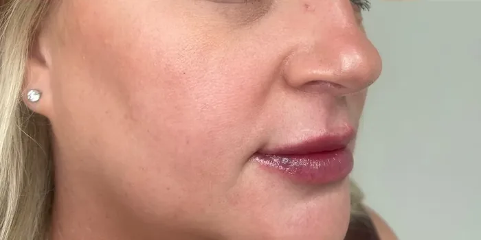 After Lip Filler before and after at Florida Aesthetics and Wellness in Brandon, FL