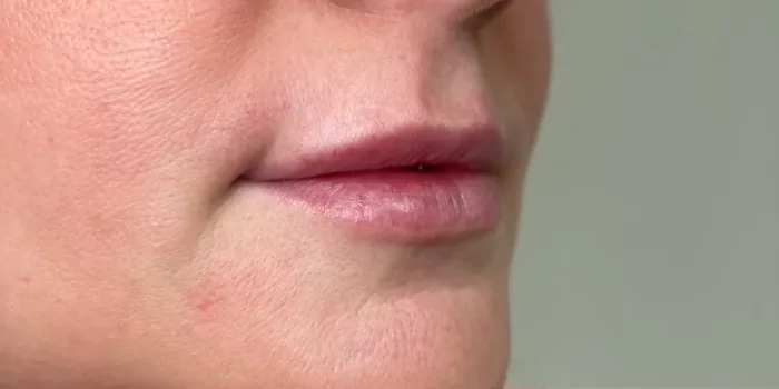 Before Lip Filler before and after at Florida Aesthetics and Wellness in Brandon, FL