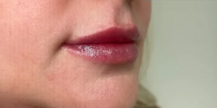 After Lip Filler before and after at Florida Aesthetics and Wellness in Brandon, FL
