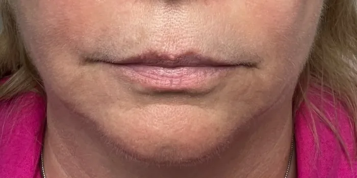 Before Lip Filler before and after at Florida Aesthetics and Wellness in Brandon, FL